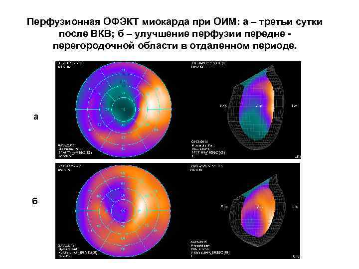 Перфузионная ОФЭКТ миокарда при ОИМ: а – третьи сутки после ВКВ; б – улучшение