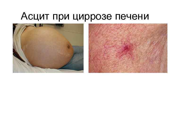 Асцит при циррозе печени 