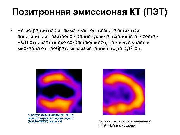 Позитронная эмиссионая КТ (ПЭТ) • Регистрация пары гамма-квантов, возникающих при аннигиляции позитронов радионуклида, входящего