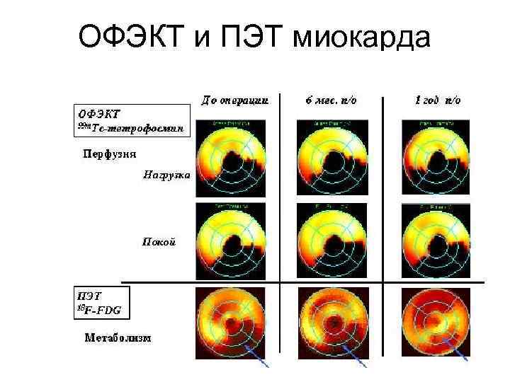 ОФЭКТ и ПЭТ миокарда 