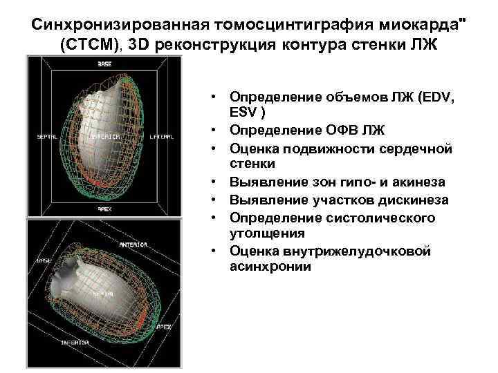 Синхронизированная томосцинтиграфия миокарда" (СТСМ), 3 D реконструкция контура стенки ЛЖ • Определение объемов ЛЖ