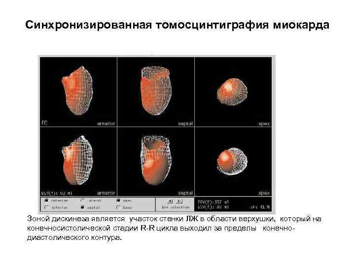 Синхронизированная томосцинтиграфия миокарда Зоной дискинеза является участок стенки ЛЖ в области верхушки, который на