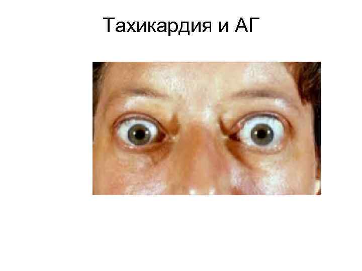 Тахикардия и АГ 