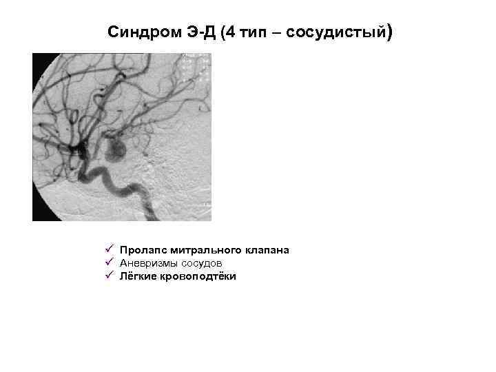 Синдром Э-Д (4 тип – сосудистый) ü Пролапс митрального клапана ü Аневризмы сосудов ü