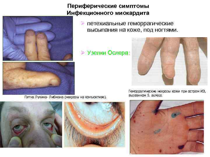 Периферические симптомы Инфекционного миокардита Ø петехиальные геморрагические высыпания на коже, под ногтями. Ø Узелки