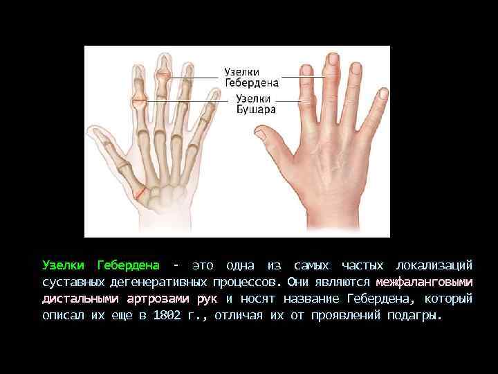 Узелки Гебердена - это одна из самых частых локализаций суставных дегенеративных процессов. Они являются