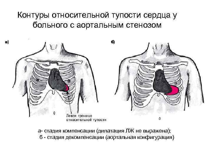 Контуры относительной тупости сердца у больного с аортальным стенозом а- стадия компенсации (дилатация ЛЖ