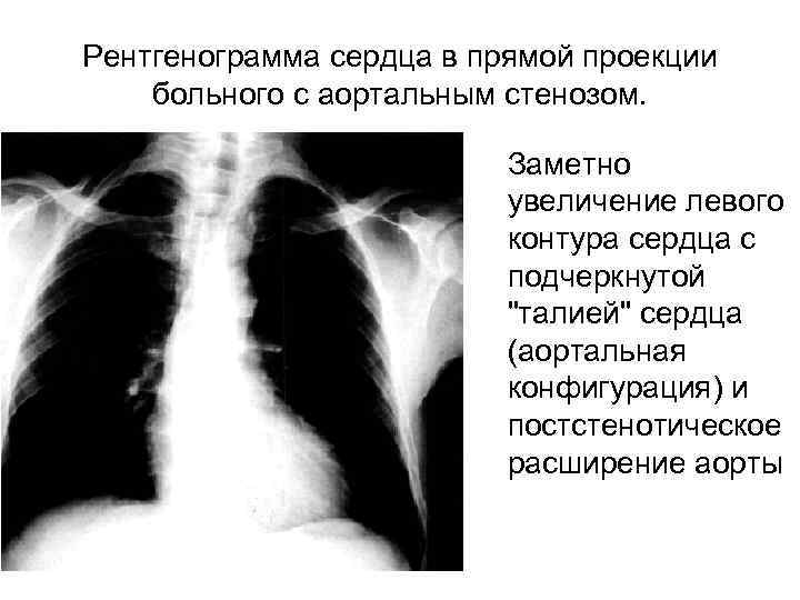 Рентгенограмма сердца в прямой проекции больного с аортальным стенозом. Заметно увеличение левого контура сердца