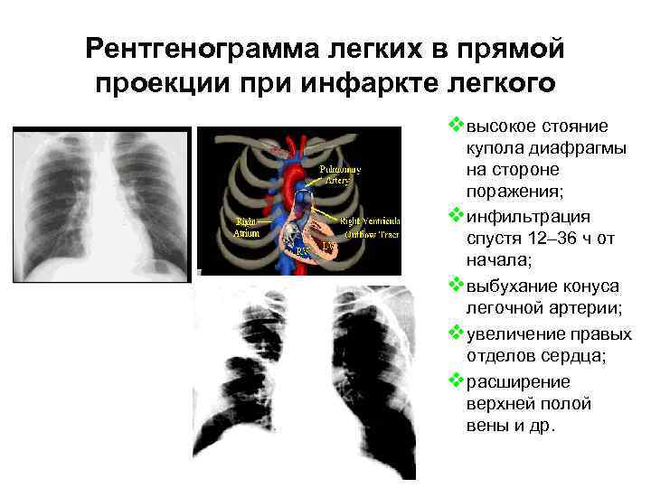 Рентгенограмма легких в прямой проекции при инфаркте легкого vвысокое стояние купола диафрагмы на стороне