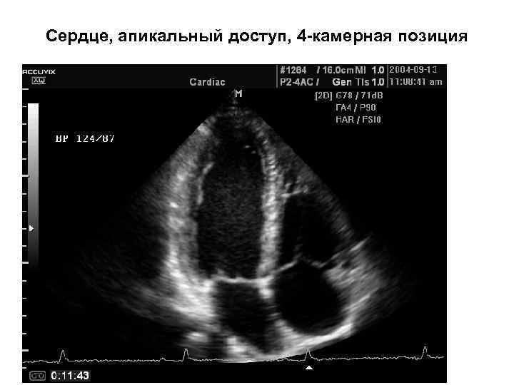 Сердце, апикальный доступ, 4 -камерная позиция 