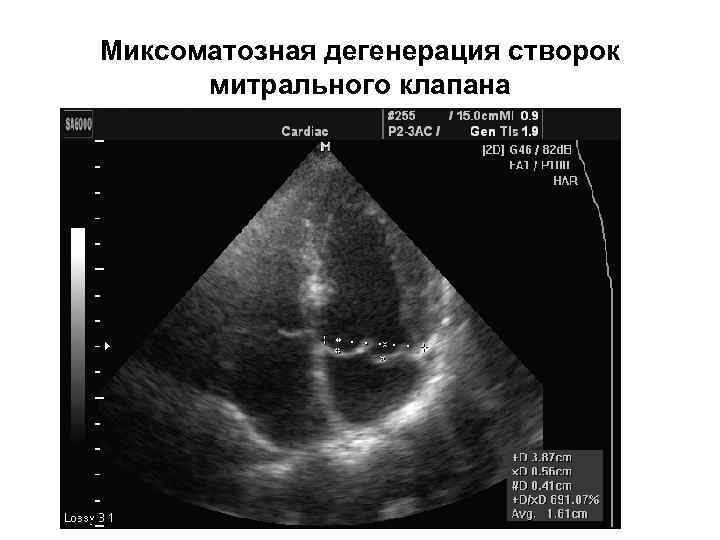 Миксоматозная дегенерация створок митрального клапана 