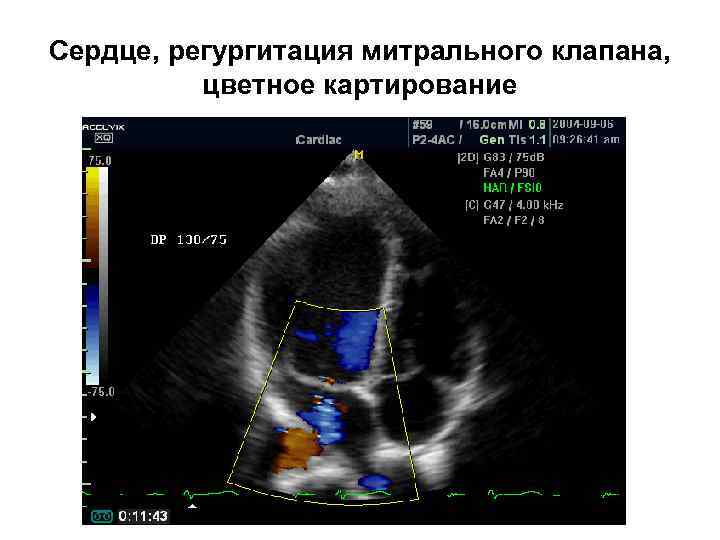 Сердце, регургитация митрального клапана, цветное картирование 