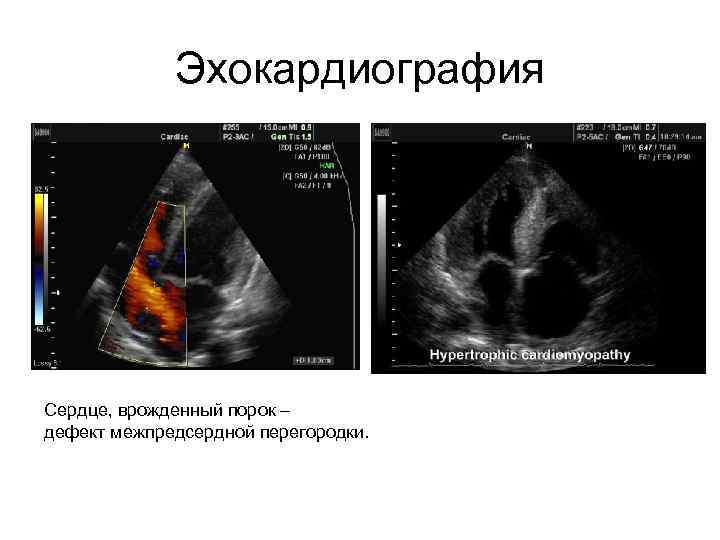 Эхокардиография Сердце, врожденный порок – дефект межпредсердной перегородки. 