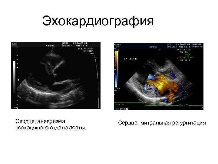 Эхокардиография Сердце, аневризма восходящего отдела аорты. Сердце, митральная регургитация 