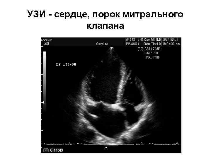 УЗИ - сердце, порок митрального клапана 