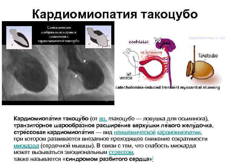 Кардиомиопатия такоцубо Кардиомиопа тия такоцу бо (от яп. такоцубо — ловушка для осьминога), транзито