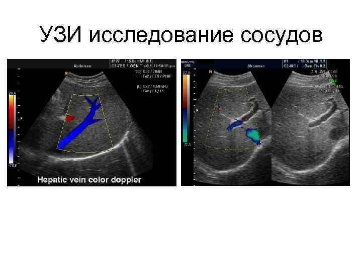 УЗИ исследование сосудов 