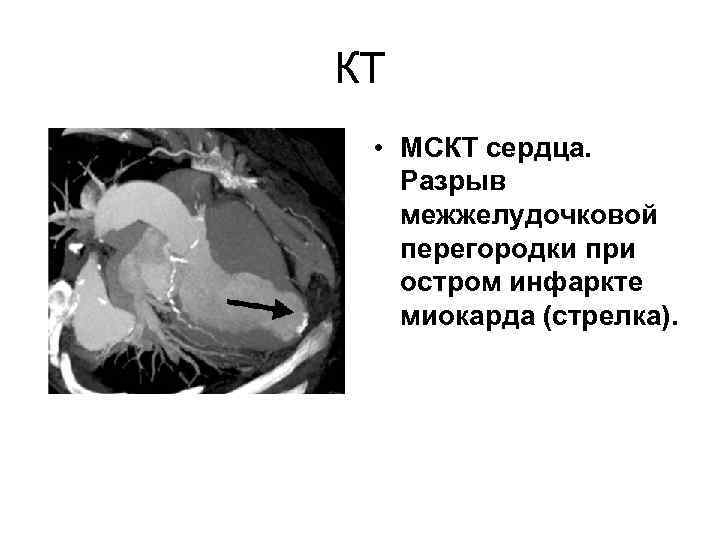 КТ • МСКТ сердца. Разрыв межжелудочковой перегородки при остром инфаркте миокарда (стрелка). 