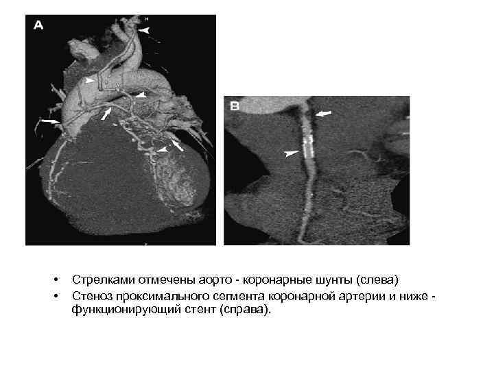  • • Стрелками отмечены аорто - коронарные шунты (слева) Стеноз проксимального сегмента коронарной