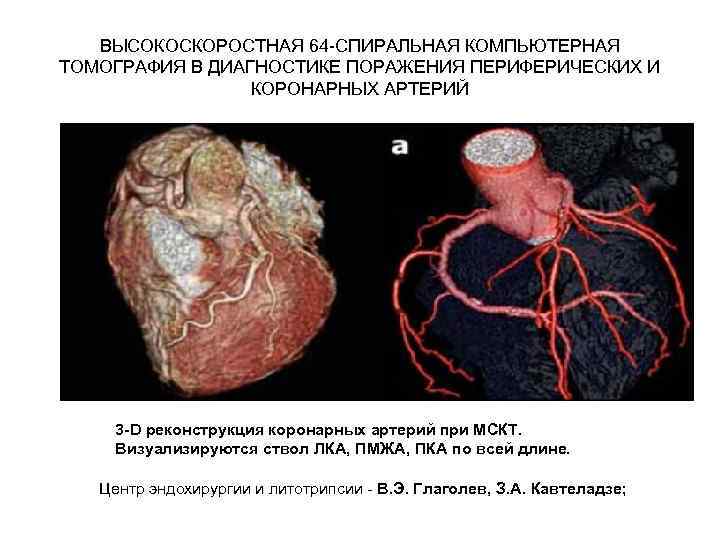 ВЫСОКОСКОРОСТНАЯ 64 -СПИРАЛЬНАЯ КОМПЬЮТЕРНАЯ ТОМОГРАФИЯ В ДИАГНОСТИКЕ ПОРАЖЕНИЯ ПЕРИФЕРИЧЕСКИХ И КОРОНАРНЫХ АРТЕРИЙ 3 -D