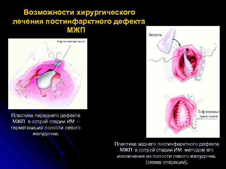 Возможности хирургического лечения постинфарктного дефекта МЖП Пластика переднего дефекта МЖП в острой стадии ИМ