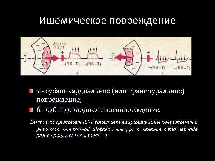 Ишемическое повреждение а - субэпикардиальное (или трансмуральное) повреждение; б - субэндокардиальное повреждение. Вектор повреждения