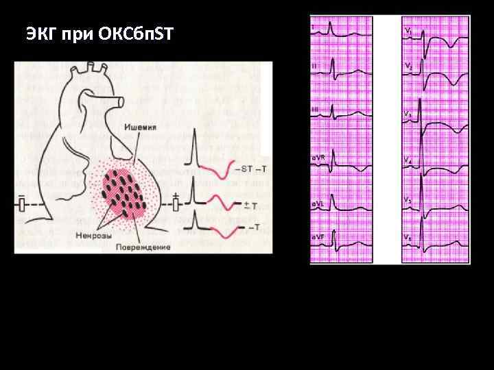 ЭКГ при ОКСбп. ST 