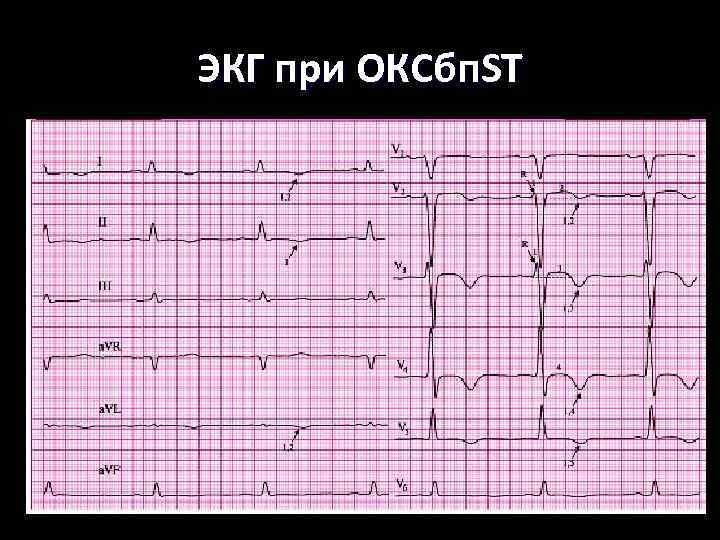ЭКГ при ОКСбп. ST 