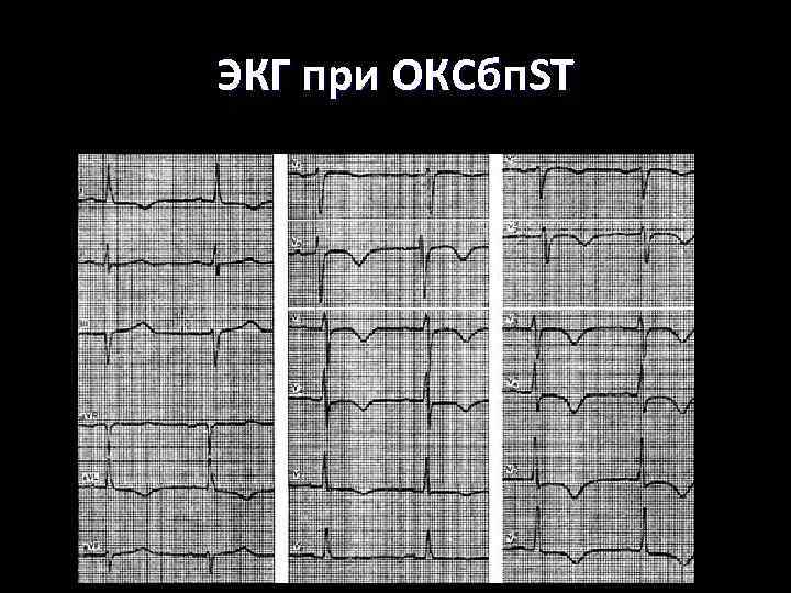ЭКГ при ОКСбп. ST 
