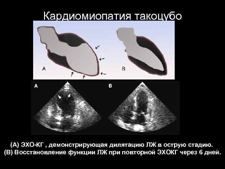 Кардиомиопатия такоцубо (A) ЭХО-КГ , демонстрирующая дилятацию ЛЖ в острую стадию. (B) Восстановление функции