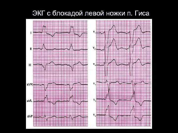 ЭКГ с блокадой левой ножки п. Гиса 