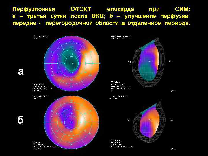 Перфузионная ОФЭКТ миокарда при ОИМ: а – третьи сутки после ВКВ; б – улучшение