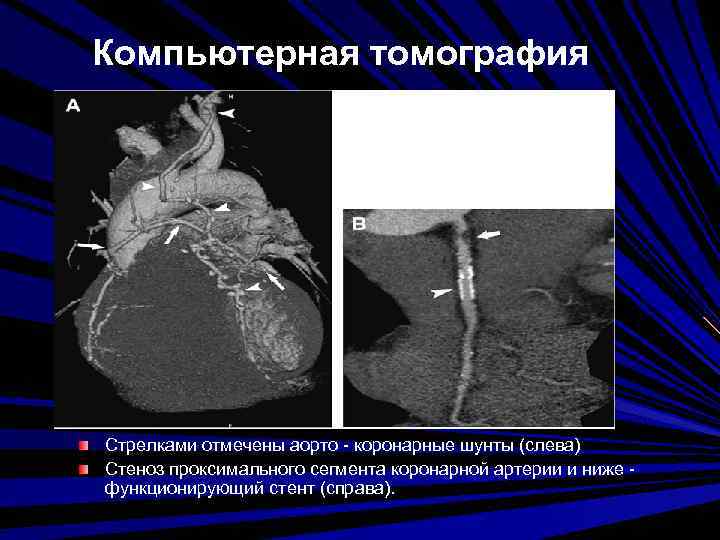 Компьютерная томография Стрелками отмечены аорто - коронарные шунты (слева) Стеноз проксимального сегмента коронарной артерии