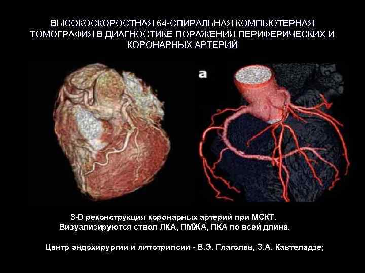 ВЫСОКОСКОРОСТНАЯ 64 -СПИРАЛЬНАЯ КОМПЬЮТЕРНАЯ ТОМОГРАФИЯ В ДИАГНОСТИКЕ ПОРАЖЕНИЯ ПЕРИФЕРИЧЕСКИХ И КОРОНАРНЫХ АРТЕРИЙ 3 -D