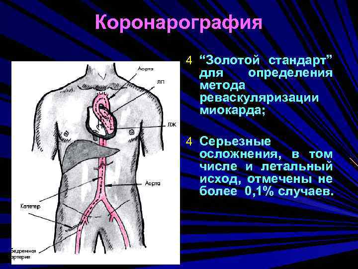 Коронарография 4 “Золотой стандарт” для определения метода реваскуляризации миокарда; 4 Серьезные осложнения, в том