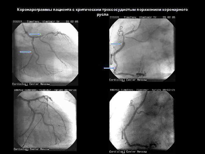 Коронарограммы пациента с критическим трехсосудистым поражением коронарного русла 