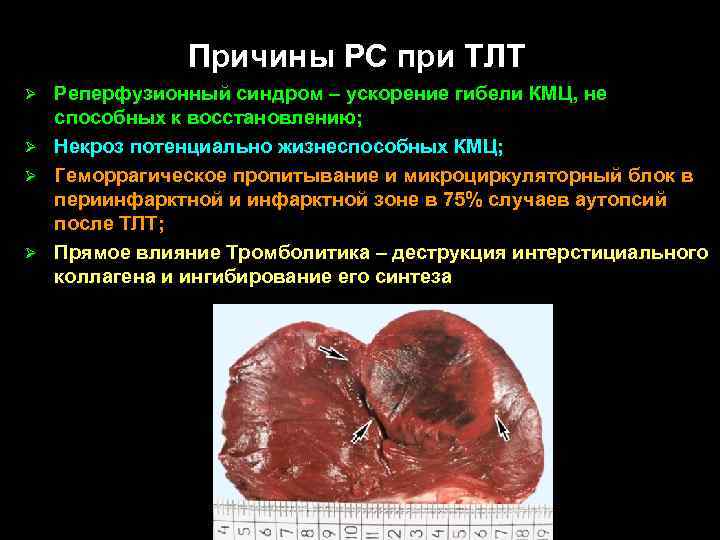 Причины РС при ТЛТ Реперфузионный синдром – ускорение гибели КМЦ, не способных к восстановлению;