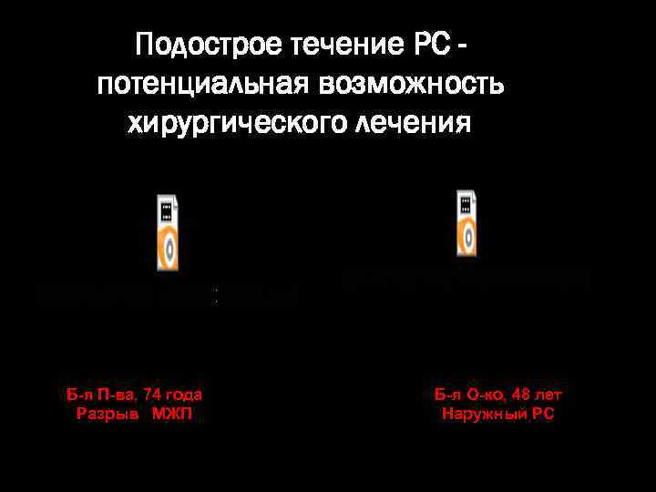 Подострое течение РС потенциальная возможность хирургического лечения Б-я П-ва, 74 года Разрыв МЖП Б-я