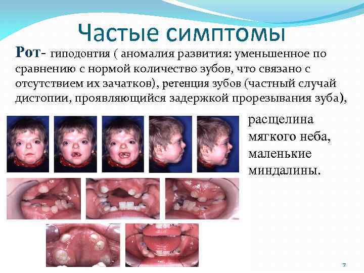 Частые симптомы Рот- гиподонтия ( аномалия развития: уменьшенное по сравнению с нормой количество зубов,