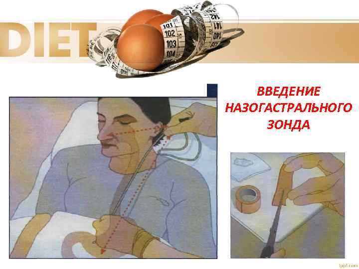 ВВЕДЕНИЕ НАЗОГАСТРАЛЬНОГО ЗОНДА 