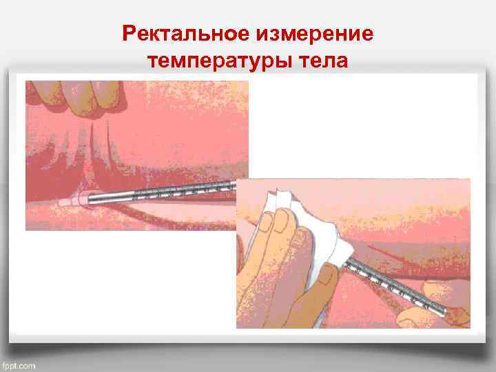 Ректальное измерение температуры тела 