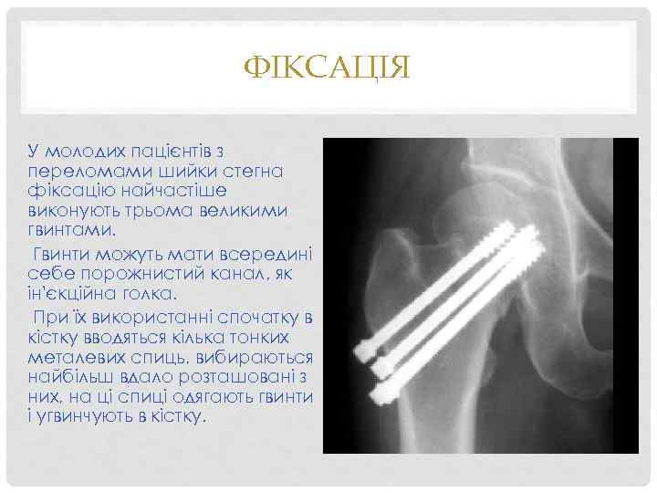 ФІКСАЦІЯ У молодих пацієнтів з переломами шийки стегна фіксацію найчастіше виконують трьома великими гвинтами.