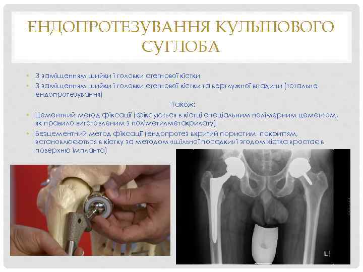 ЕНДОПРОТЕЗУВАННЯ КУЛЬШОВОГО СУГЛОБА • З заміщенням шийки і головки стегнової кістки та вертлужної впадини