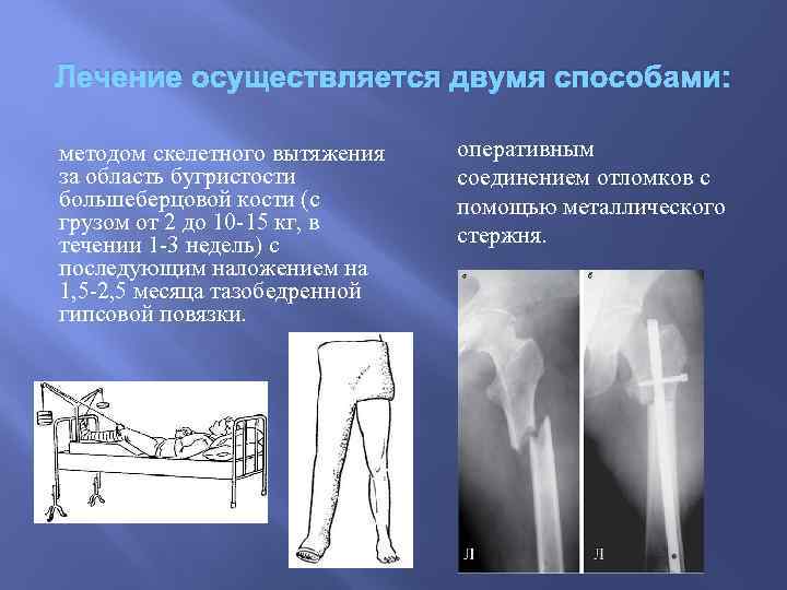 Лечение осуществляется двумя способами: методом скелетного вытяжения за область бугристости большеберцовой кости (с грузом