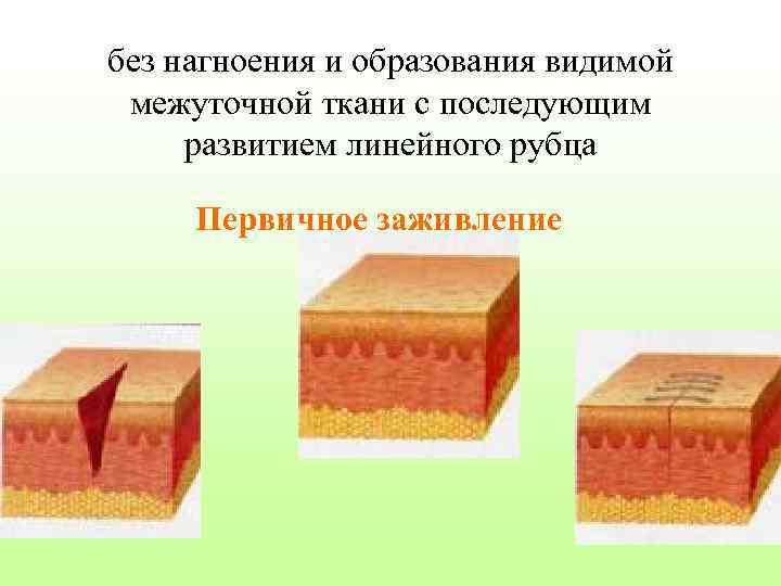 без нагноения и образования видимой межуточной ткани с последующим развитием линейного рубца Первичное заживление