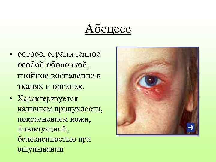 Абсцесс • острое, ограниченное особой оболочкой, гнойное воспаление в тканях и органах. • Характеризуется