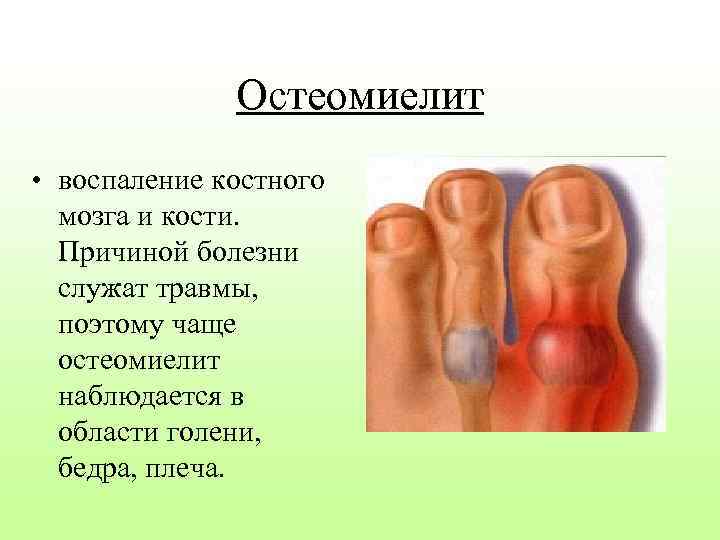 Остеомиелит • воспаление костного мозга и кости. Причиной болезни служат травмы, поэтому чаще остеомиелит