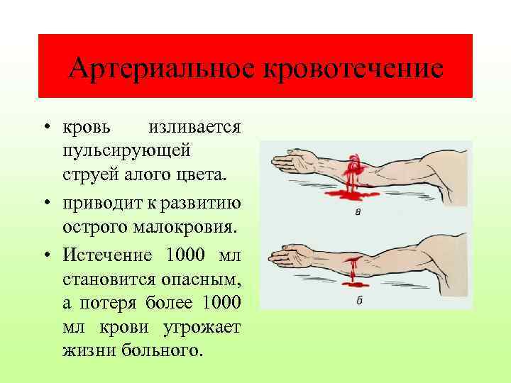 Артериальное кровотечение • кровь изливается пульсирующей струей алого цвета. • приводит к развитию острого