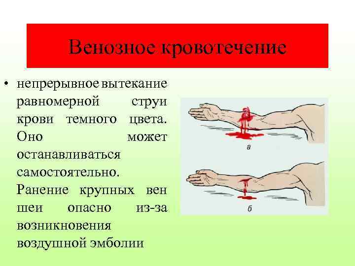 Венозное кровотечение • непрерывное вытекание равномерной струи крови темного цвета. Оно может останавливаться самостоятельно.