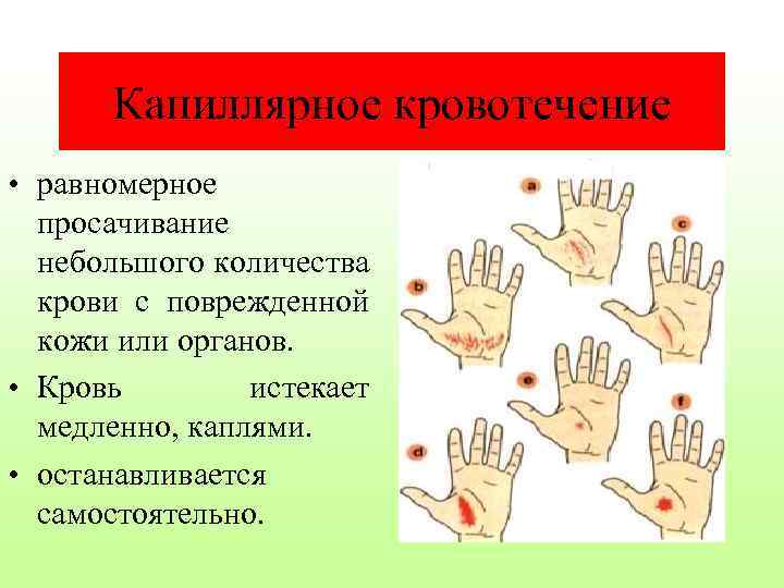 Капиллярное кровотечение • равномерное просачивание небольшого количества крови с поврежденной кожи или органов. •